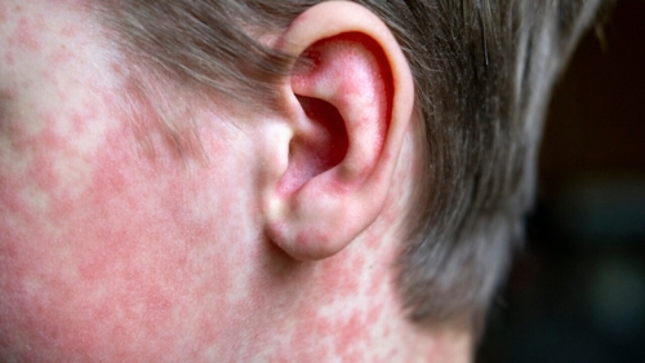 Another Measles Case In Virginia: Second Confirmed Infection In 2025 Another Measles Case In Virginia: Second Confirmed Infection In 2025