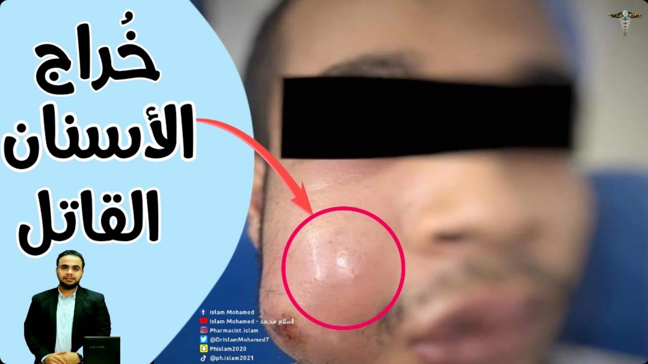 باربوزا و كارثة ماراكانا: تفاصيل فقدان الأسنان