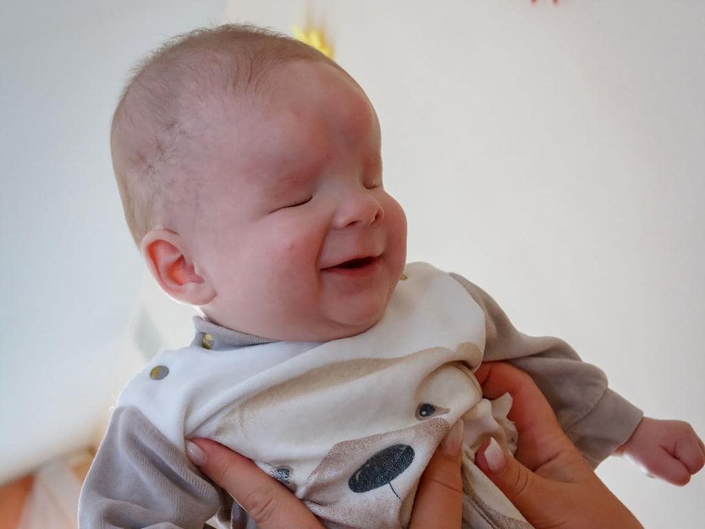 Bilateral Anophthalmia: Understanding The Rare Condition Of Babies Born Without Eyes Bilateral Anophthalmia: Understanding The Rare Condition Of Babies Born Without Eyes