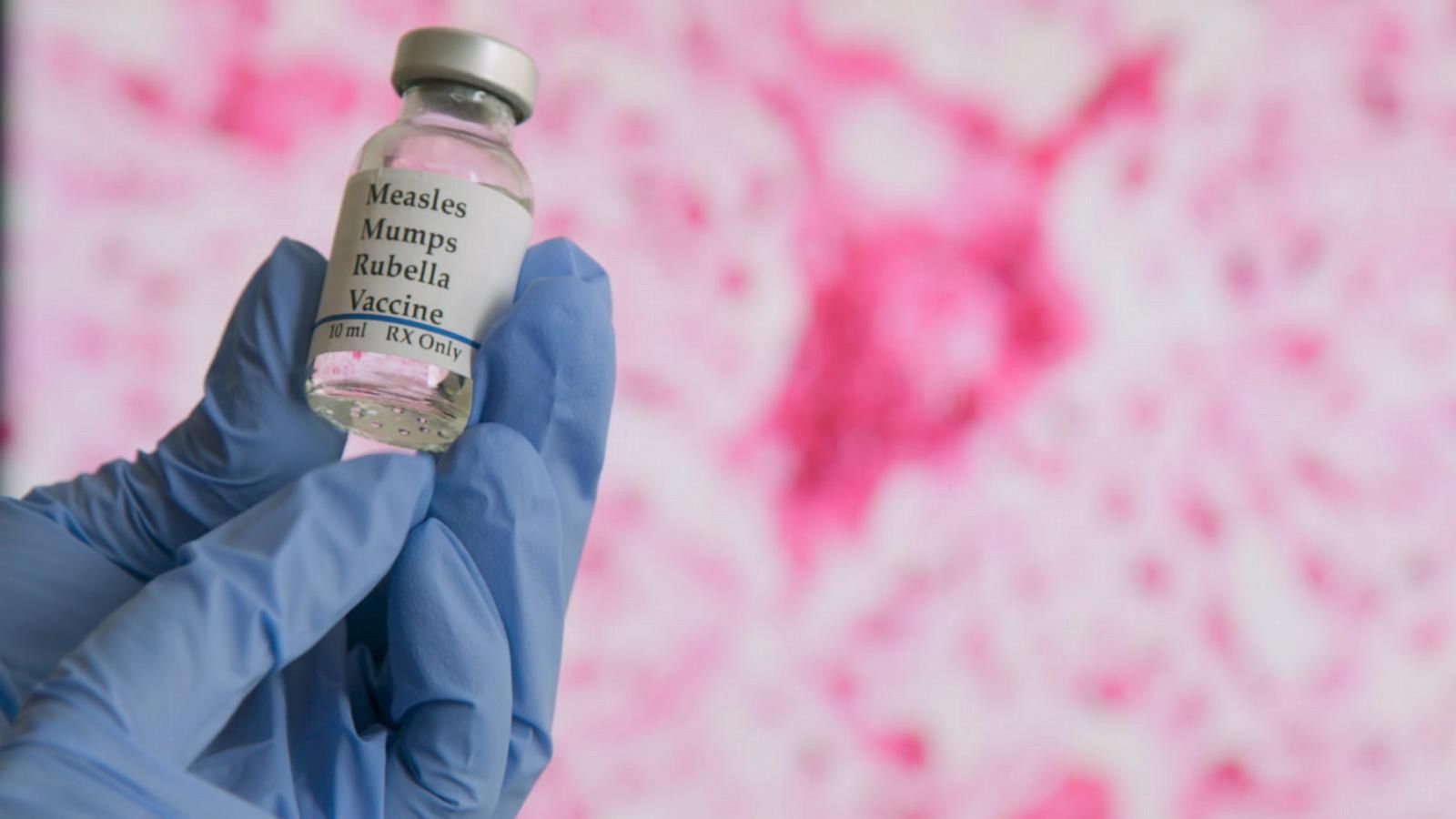 Measles Detected In Sacramento County Wastewater: Officials Issue Warning Measles Detected In Sacramento County Wastewater: Officials Issue Warning