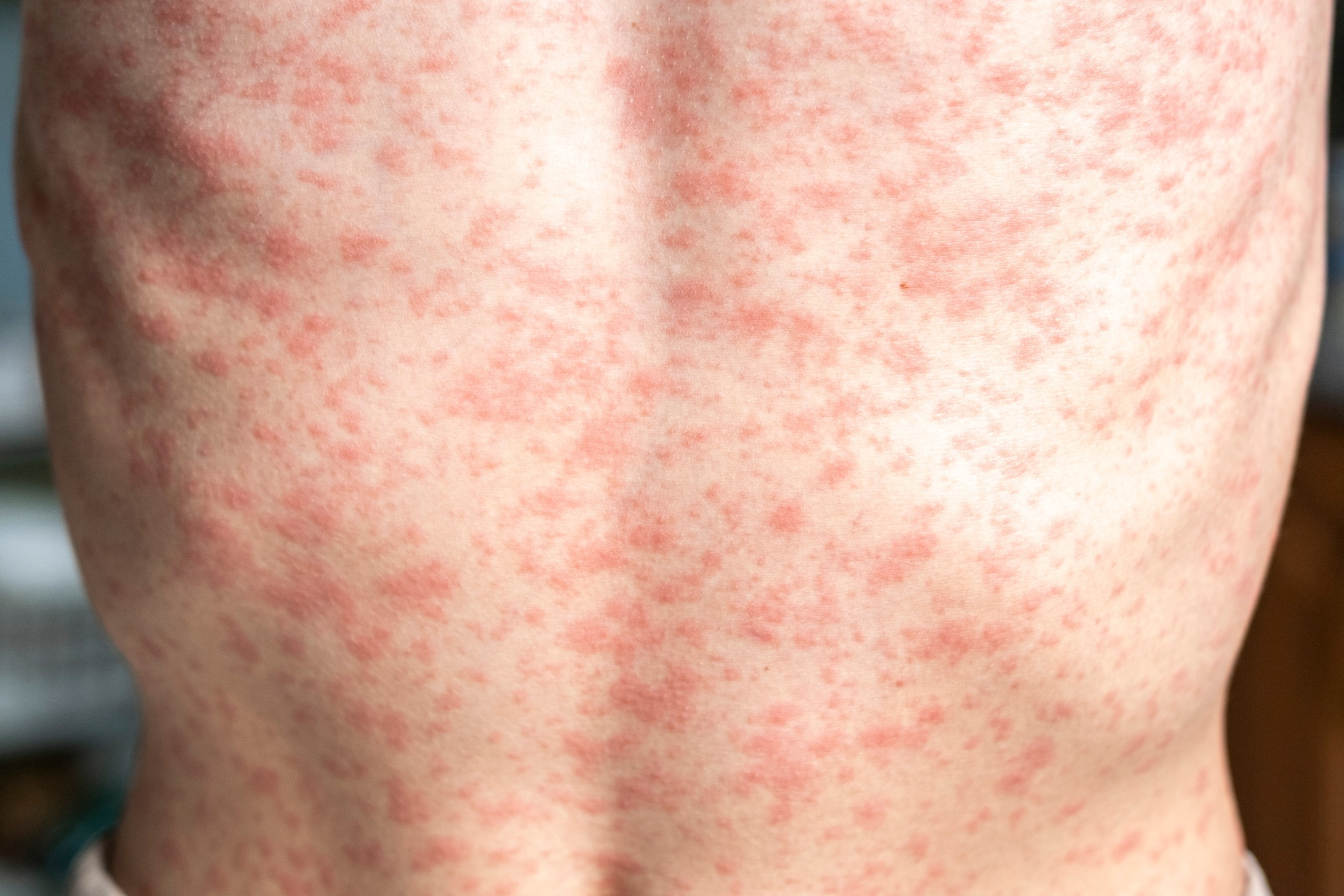 Measles Outbreak Concerns: Virginia Announces Second Case Of 2025 Measles Outbreak Concerns: Virginia Announces Second Case Of 2025