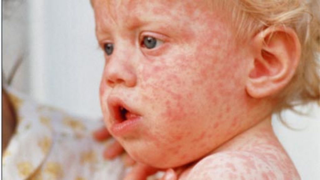 Measles Outbreak In North Dakota: School Quarantine For Unvaccinated Children Measles Outbreak In North Dakota: School Quarantine For Unvaccinated Children