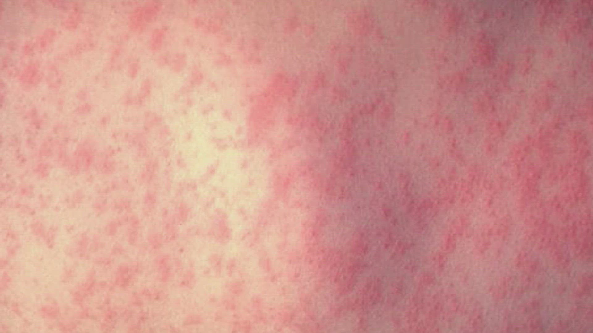 Measles Outbreak Prompts School Quarantine In North Dakota: Unvaccinated Children Affected Measles Outbreak Prompts School Quarantine In North Dakota: Unvaccinated Children Affected