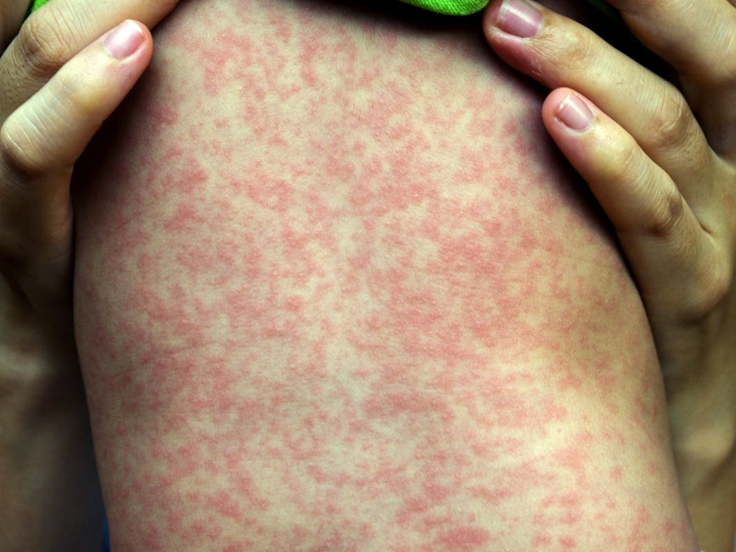Second Measles Case Confirmed In Virginia For 2025: Public Health Alert Second Measles Case Confirmed In Virginia For 2025: Public Health Alert