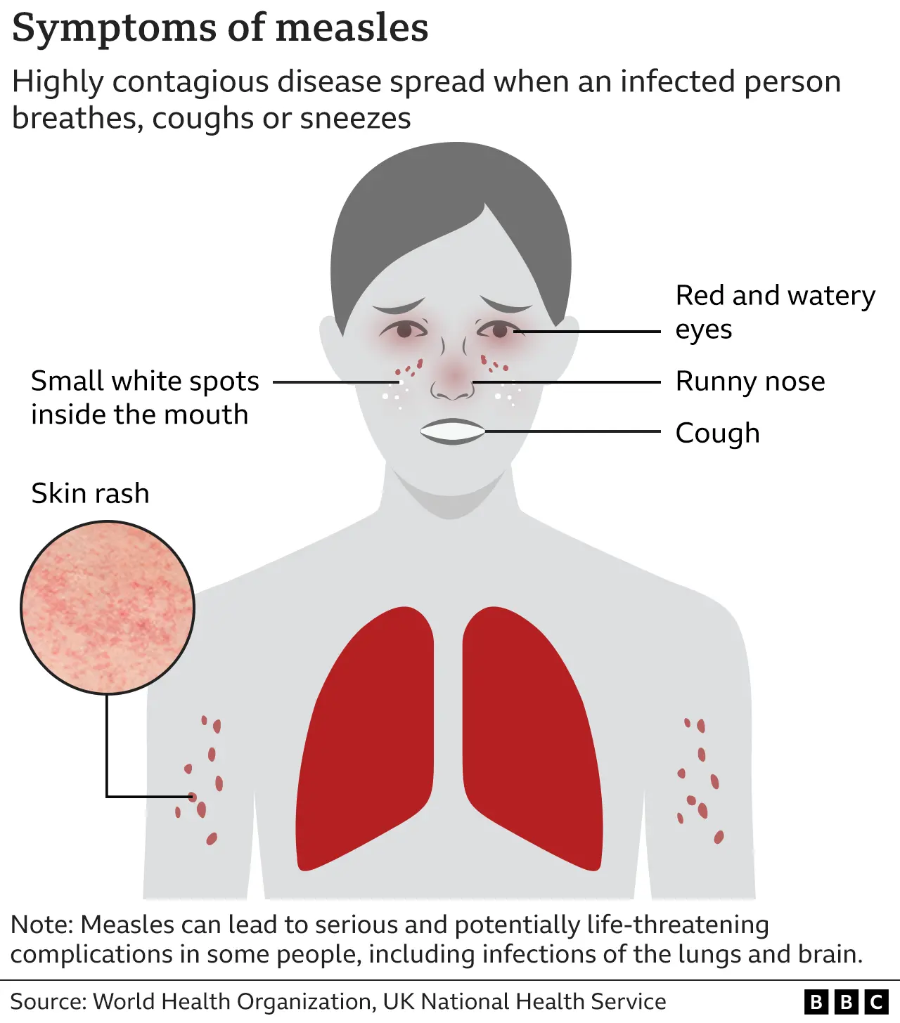 Texas Measles Cases Rise: Increase Unrelated To Main Outbreak Texas Measles Cases Rise: Increase Unrelated To Main Outbreak