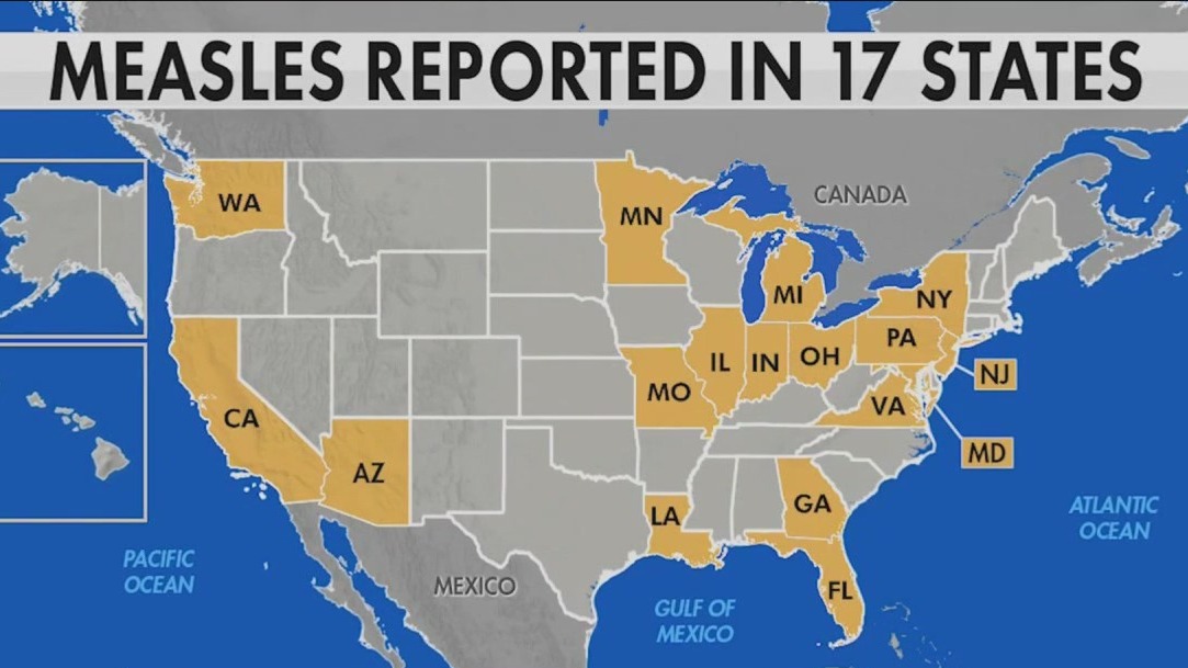 US Measles Cases Rise To 1,046: Indiana Outbreak Concludes US Measles Cases Rise To 1,046: Indiana Outbreak Concludes