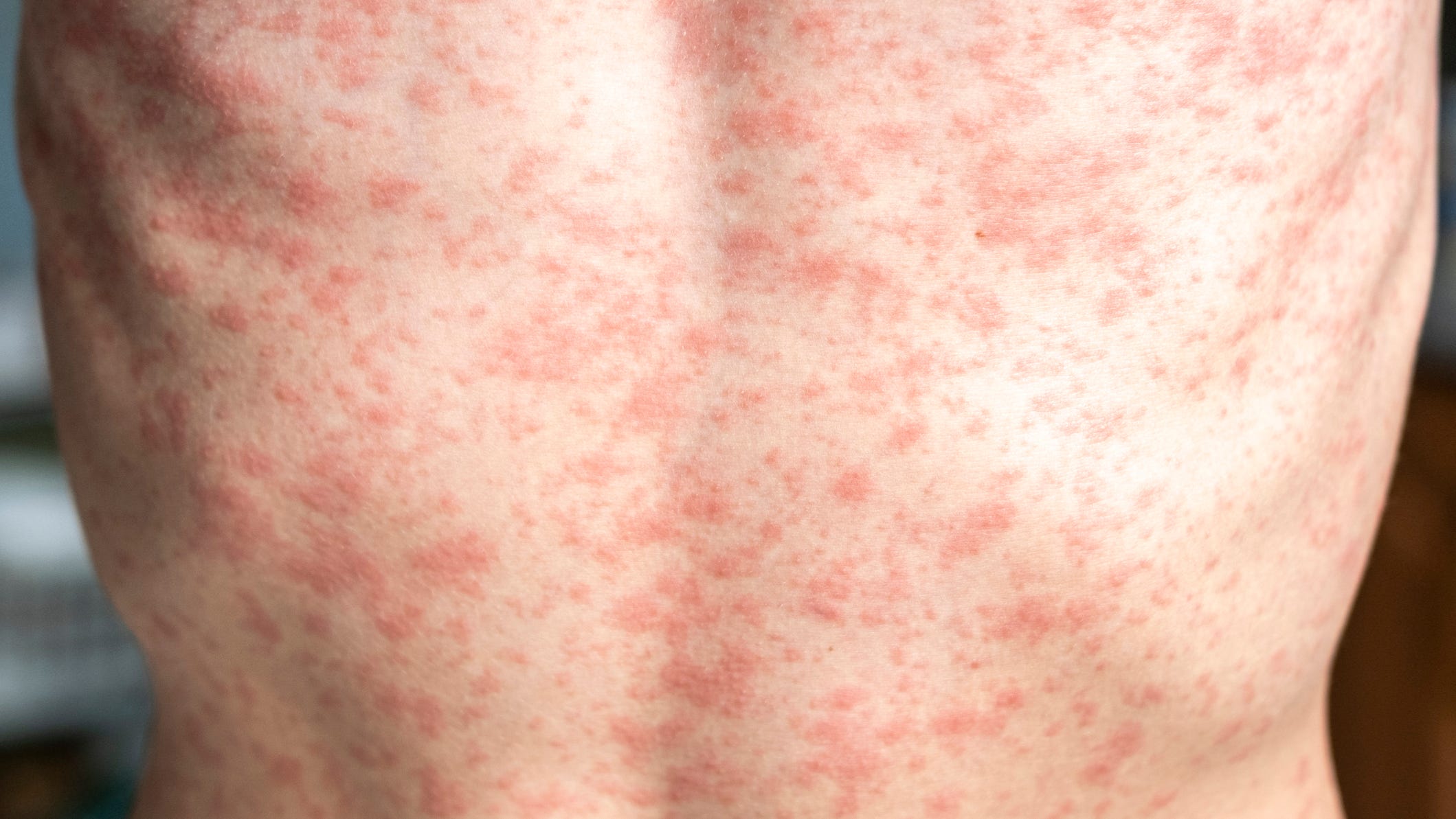 Virginia Confirms Second Measles Case In 2025: What You Need To Know Virginia Confirms Second Measles Case In 2025: What You Need To Know
